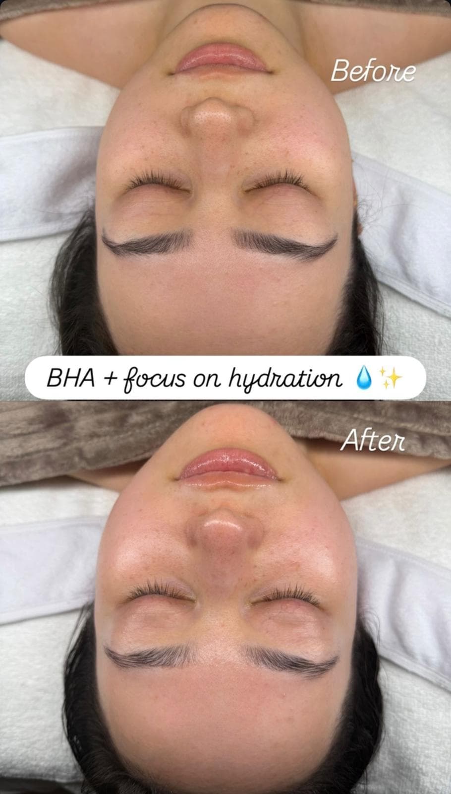 Facial before and after BHA exfoliation and hydration