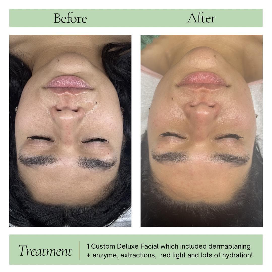 Custom Deluxe Facial before and after with dermaplaning and red light