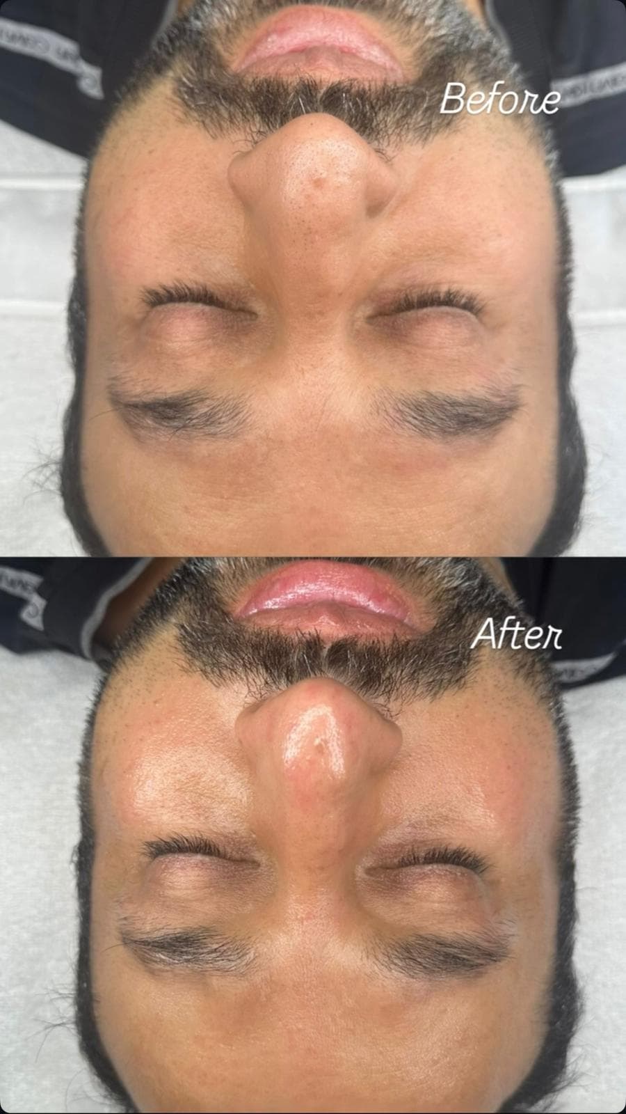 Facial before and after deep cleanse and extractions