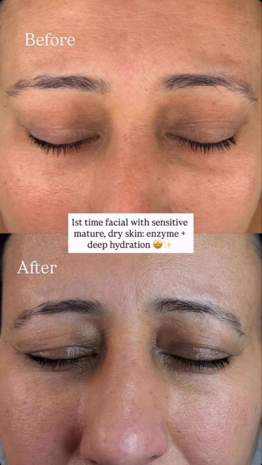 Facial before and after enzyme and deep hydration treatment