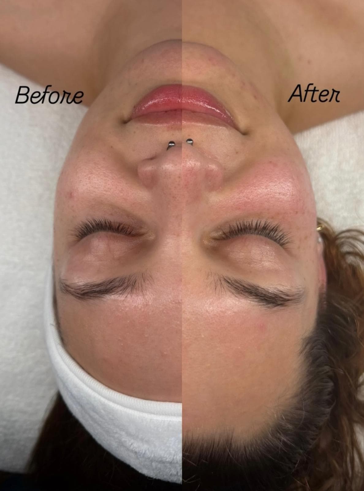 Facial before and after split side-by-side comparison