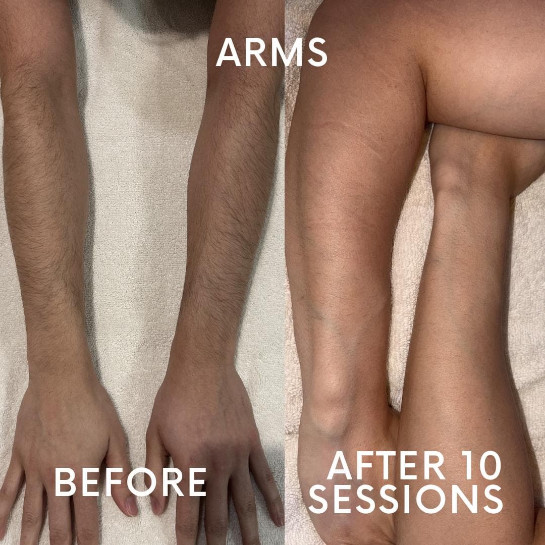 Full arm laser hair removal before and after 10 sessions