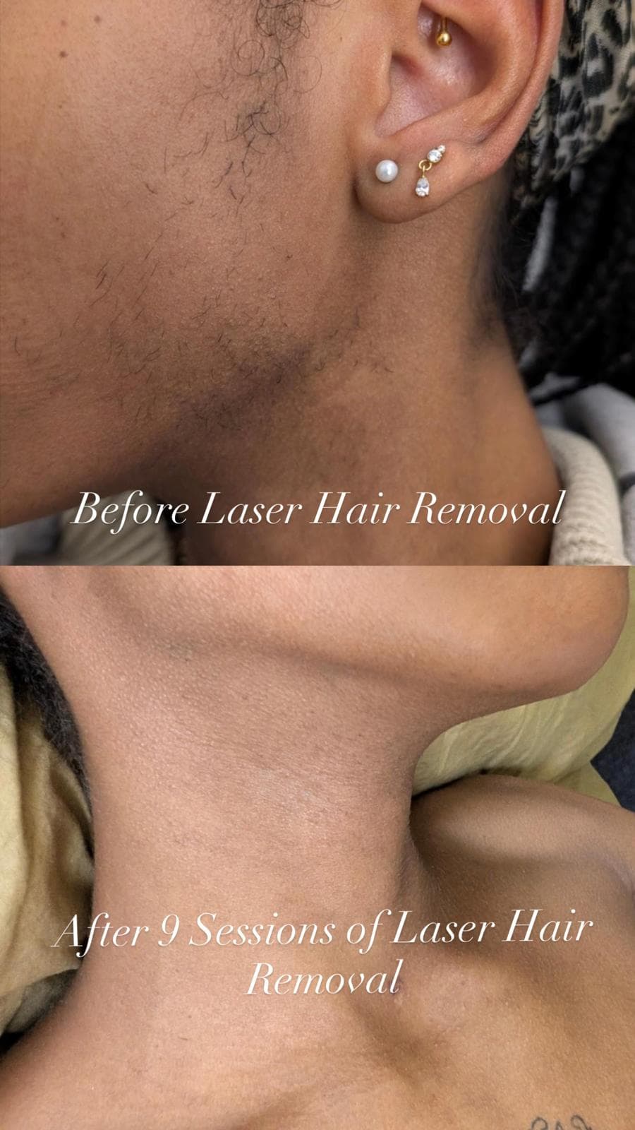 Jawline and neck laser hair removal before and after 9 sessions