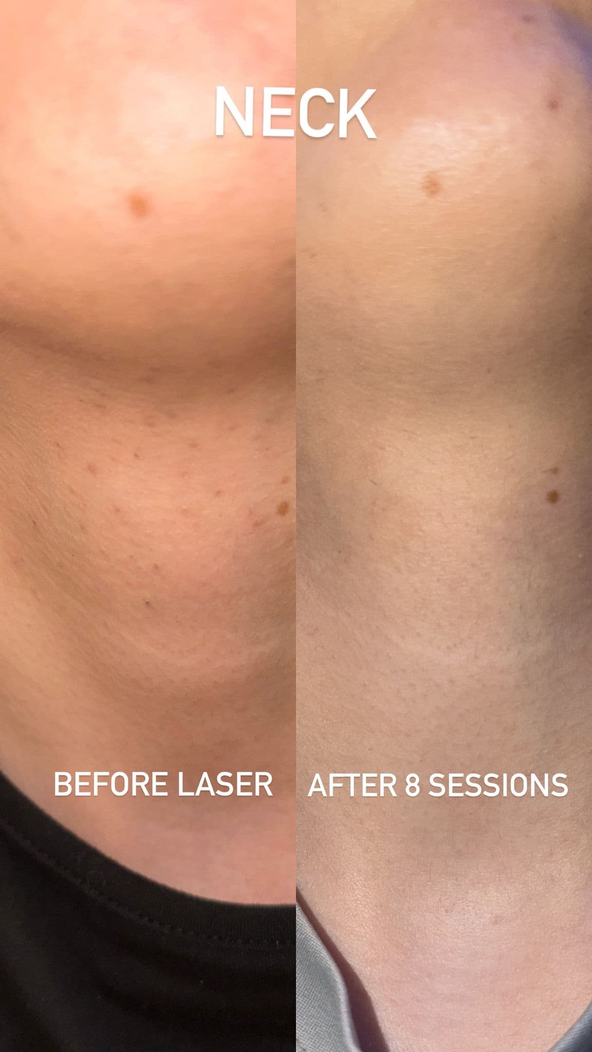Neck laser hair removal before and after 8 sessions