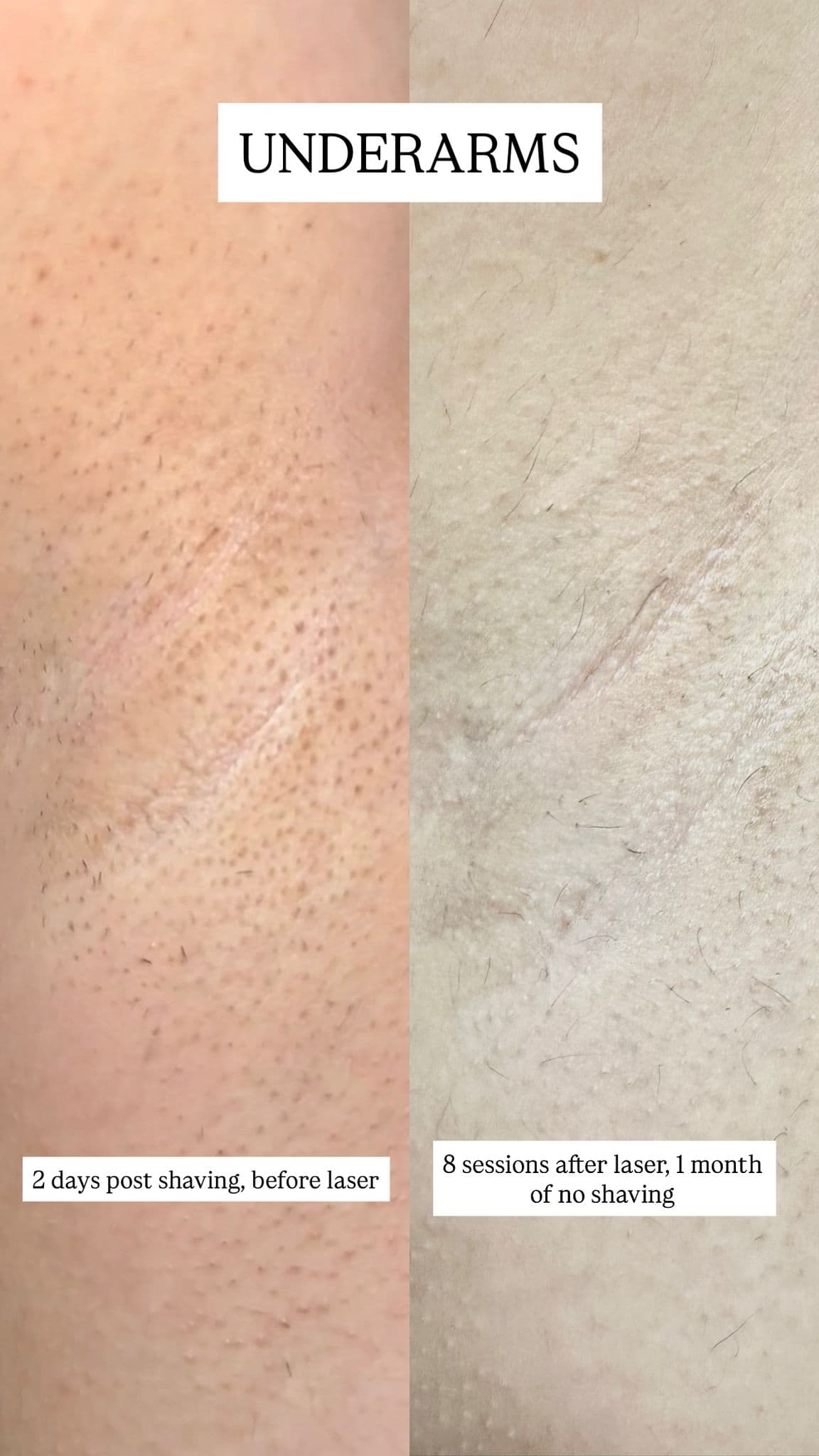 Underarm laser hair removal before and after at Luxe Woodbridge