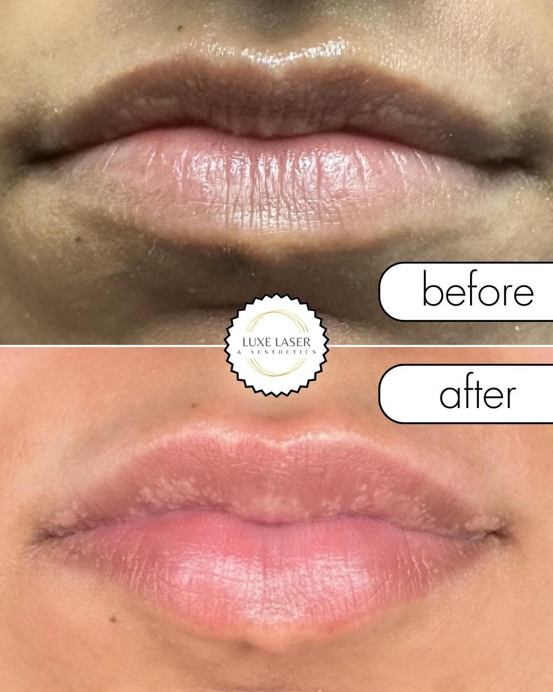 Lip filler before and after with fuller defined shape