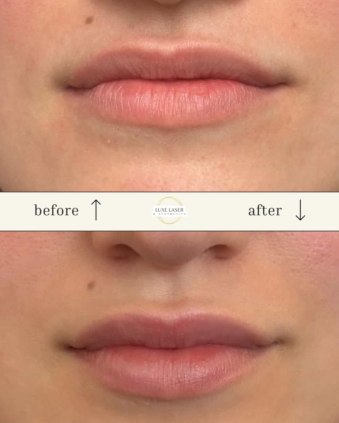 Lip filler before and after showing soft natural enhancement