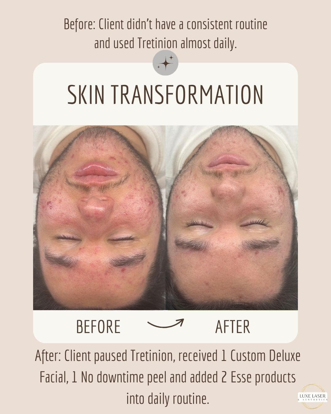 Skin transformation before and after custom deluxe facial no downtime peel and Esse products